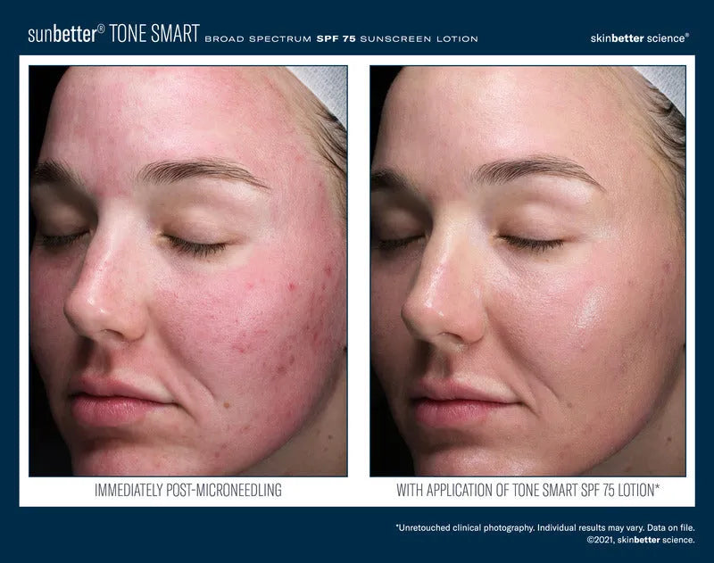 Before-and-after of a woman using Sunbetter Tone Smart SPF 75 Lotion, showing reduced redness and smoother, more even-toned skin.