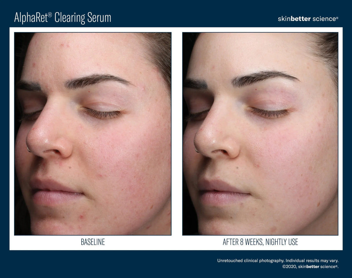 Before-and-after photos of a woman's face from skinbetter's AlphaRet Clearing Serum clinical photography, labelled 8 weeks.