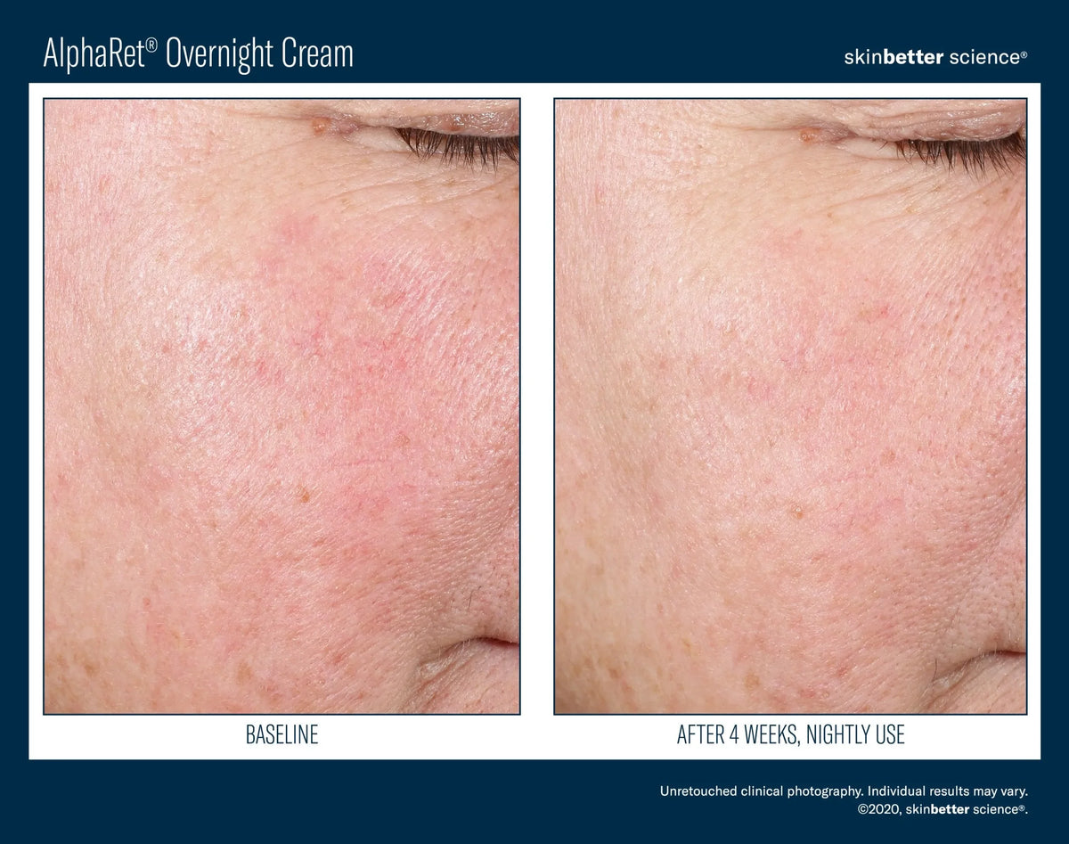 Before-and-after photos of a woman's cheek from skinbetter's AlphaRet Overnight Cream clinical photography, labelled 4 weeks.