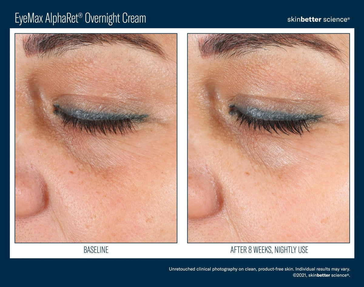 Before-and-after photos of a woman's under-eye area from skinbetter's EyeMax AlphaRet Overnight Cream, labelled 8 weeks.