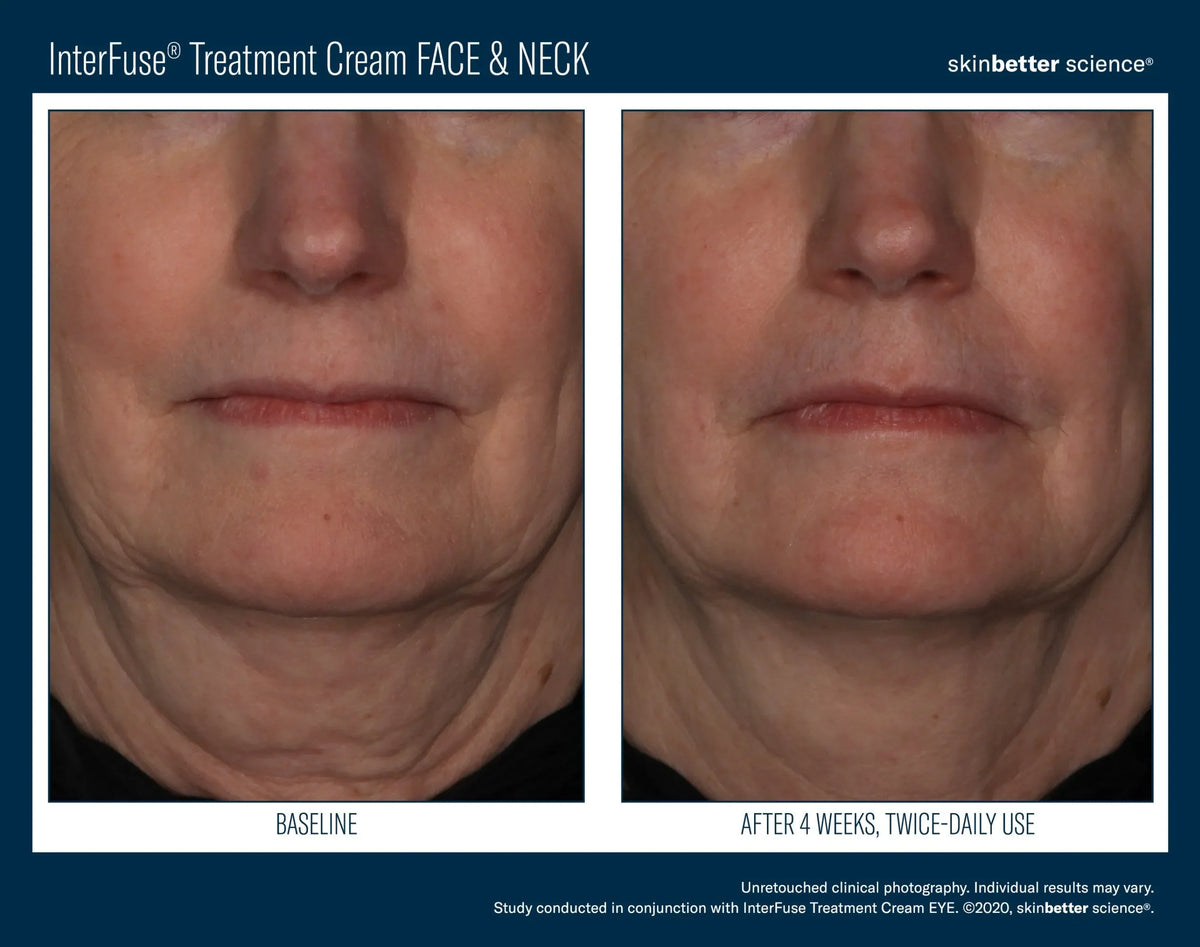 skinbetter InterFuse Treatment Cream Face and Neck bottle rotated to show its label and cross-hatch pattern.