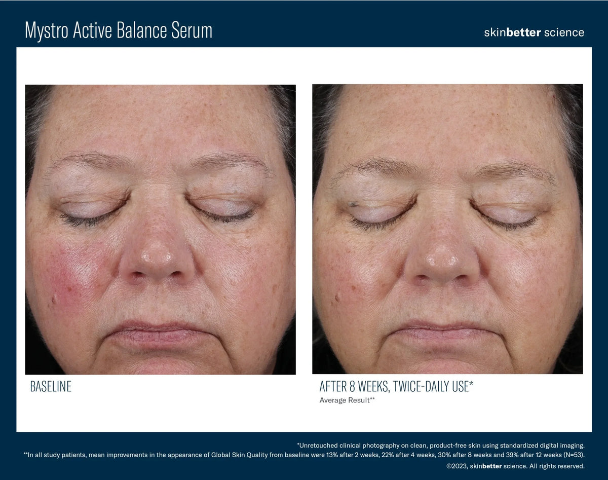 Before-and-after photos of a woman's face with eyes closed from skinbetter's Mystro Active Balance Serum, labelled 8 weeks.