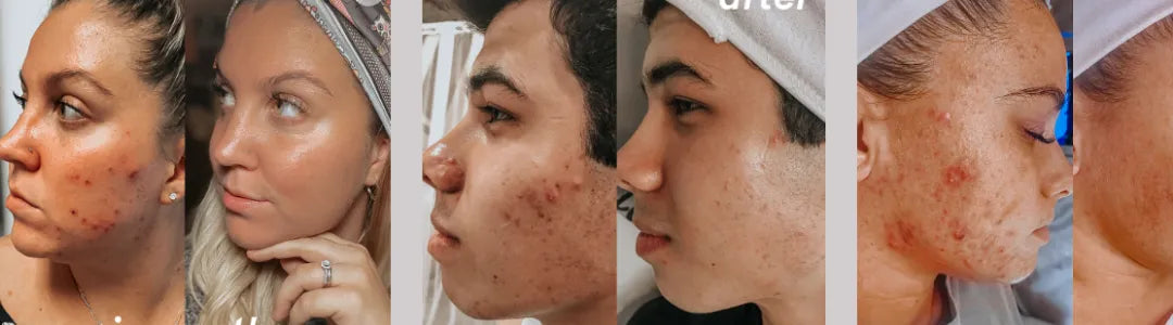 Before and after acne skincare results, close-up faces using Bohemia Skin holistic products.
