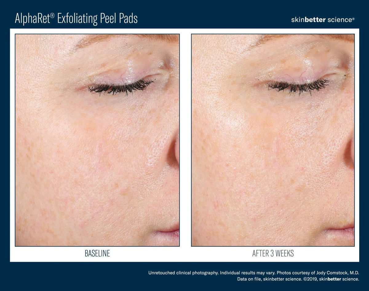 Side-by-side close-up of facial skin before and after using exfoliating peel pads, showing improved skin texture.