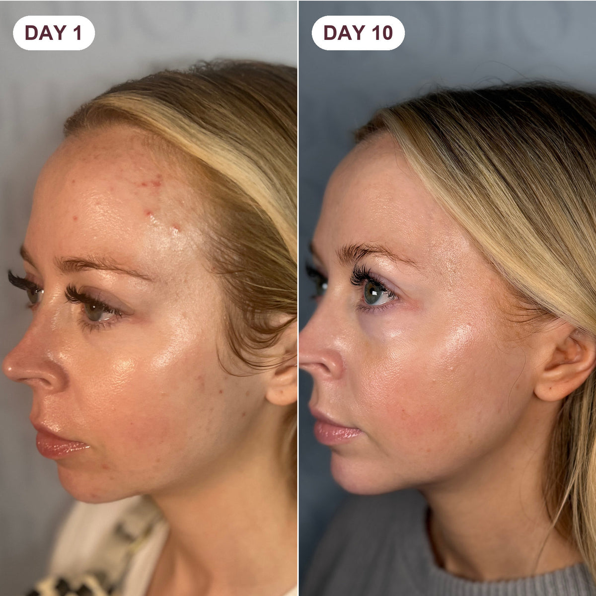 Kaylee Dudley, day 1 and day 10, photographed before and after ten days of use. Results vary.