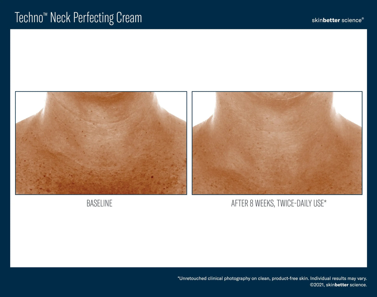 Before-and-after photos of a woman's neck and chest from skinbetter's Techno Neck Perfecting Cream, labelled 8 weeks.