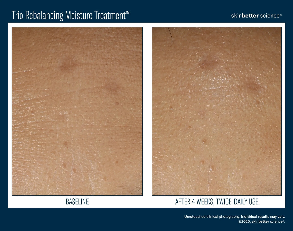 Before-and-after skin texture close-up from skinbetter's Trio Rebalancing Moisture Treatment, labelled 4 weeks.